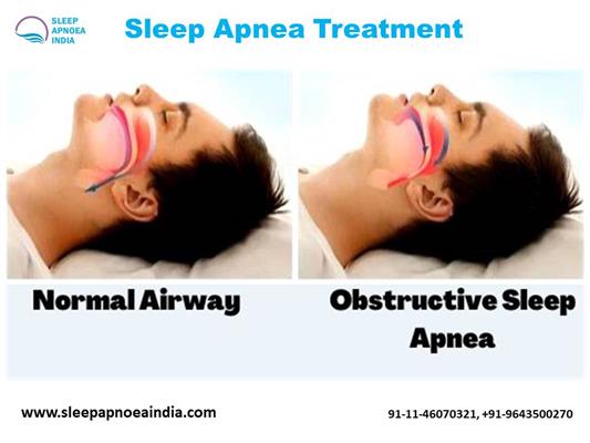 sleep apnoea india