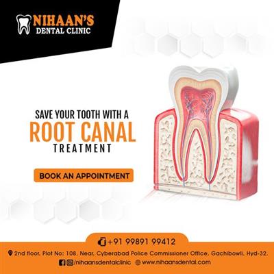 best root canal treatment in gachibowli