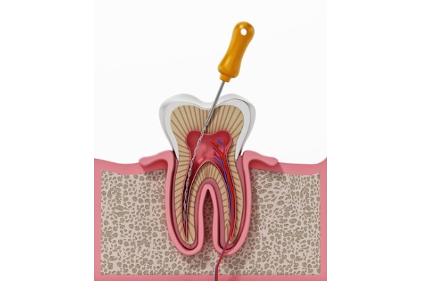 root canal treatment in gurugram | dental in gurugram